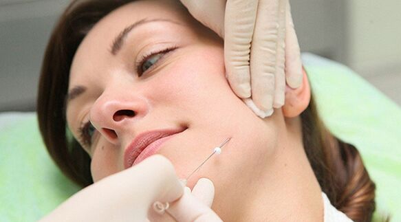 Thread lift a method of cosmetic rejuvenation of the face after 45 years. 