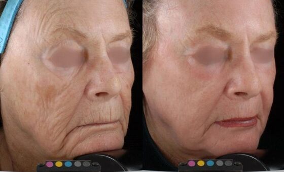 photo before and after laser resurfacing