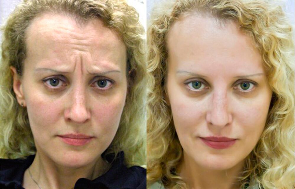 before and after using the ltza rejuvenation massager photo 1