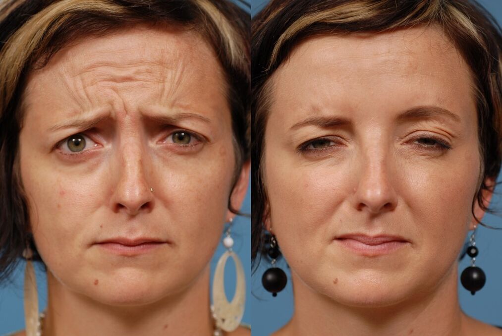 before and after using the ltza rejuvenation massager photo 2