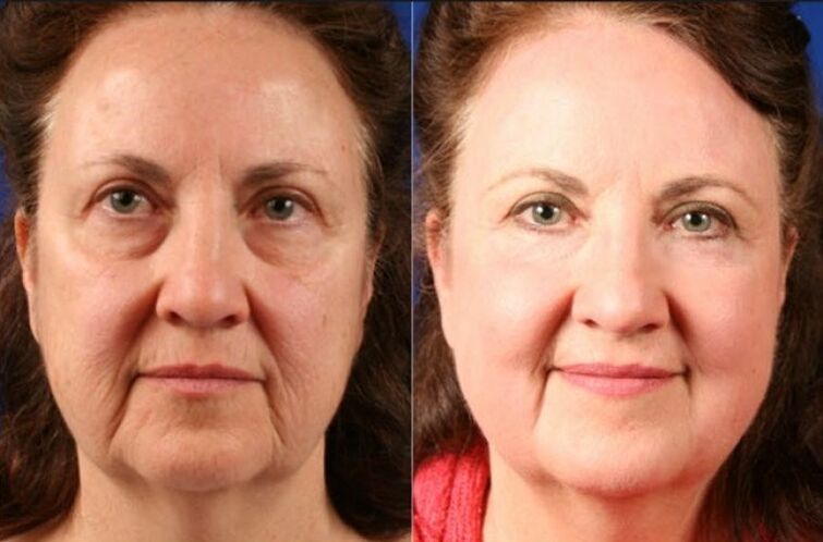 before and after using the ltza rejuvenation massager photo 6