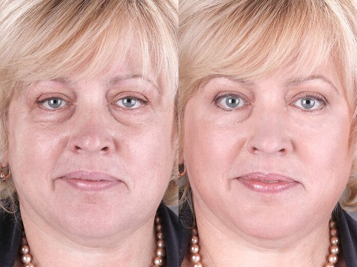 before and after using the massager to rejuvenate ltza photo 3