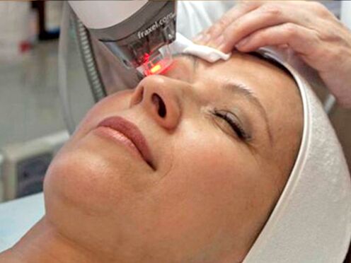laser resurfacing of the skin around the eyes
