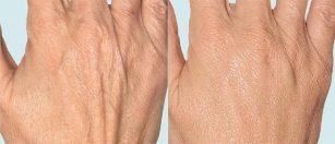 Skin of the hands before and after fractional therapy. 
