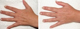 The result of removing age spots from hands. 